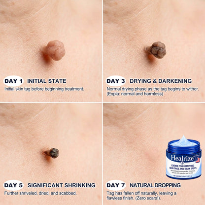 𝐇𝐞𝐚𝐥𝐫𝐢𝐳𝐞® 𝟕-𝐃𝐚𝐲 𝐒𝐤𝐢𝐧 𝐓𝐚𝐠 & 𝐒𝐩𝐨𝐭 𝐄𝐫𝐚𝐬𝐞𝐫 𝐂𝐫𝐞𝐚𝐦 (𝐙𝐞𝐫𝐨 𝐏𝐚𝐢𝐧, 𝐙𝐞𝐫𝐨 𝐒𝐜𝐚𝐫𝐬 𝐅𝐨𝐫𝐦𝐮𝐥𝐚)💎