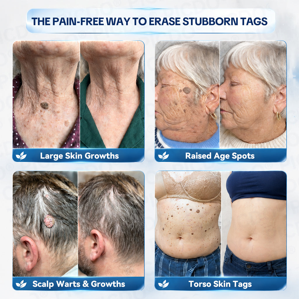 𝐏𝐡𝐚𝐫𝐦𝐚𝐜𝐢𝐬𝐭 𝐑𝐞𝐜𝐨𝐦𝐦𝐞𝐧𝐝𝐞𝐝🥇𝐏𝐢𝐜𝐝𝐨® 7-𝐃𝐚𝐲 𝐒𝐤𝐢𝐧 𝐓𝐚𝐠 & 𝐒𝐩𝐨𝐭 𝐄𝐫𝐚𝐬𝐞𝐫 𝐂𝐫𝐞𝐚𝐦 🌿(Zero Pain, Zero 𝐒𝐜𝐚𝐫𝐬 Formula)🧊🧊