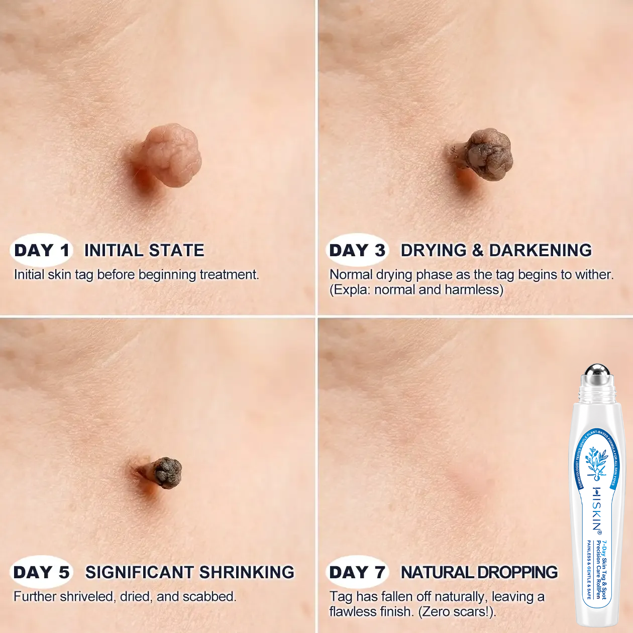 𝗛𝗜𝗦𝗞𝗜𝗡®👩‍⚕️ 𝟕-𝐃𝒂𝘆 𝐒𝗸𝐢𝐧 𝐓𝒂𝗴 & 𝐒𝐩𝙤𝐭 𝐄𝐫𝒂𝐬𝙚𝐫 Painless & Scar-Free Advanced Imperfection Removal Rollerball Pen🎉🎉