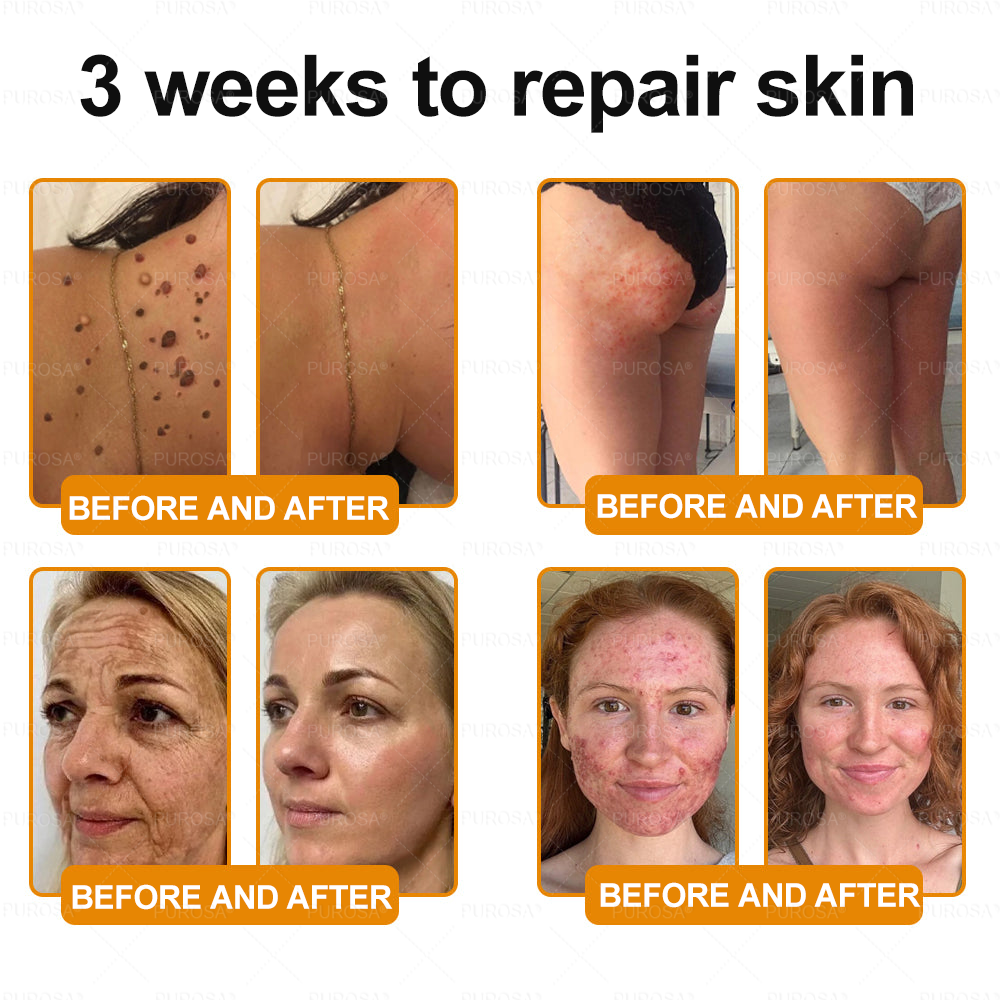 Made and Shipped from USA 🎇 VLSVLS® Bee Venom Skin Restoration Cream 🔥 LAST DAY 80% OFF🔅